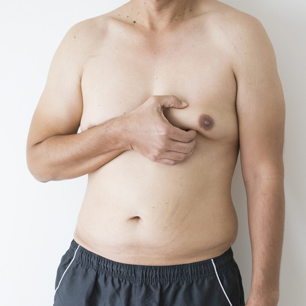 Gynaecomastia – Ramana Cosmetic Surgery